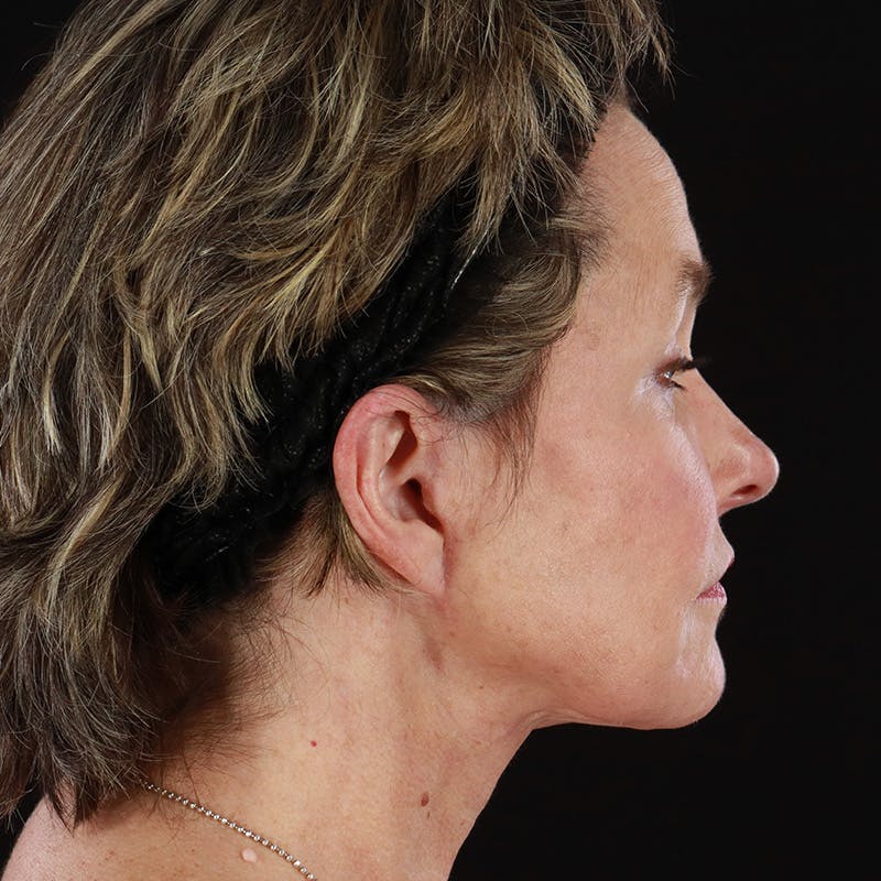 Facelift Before & After Gallery - Patient 135426 - Image 6