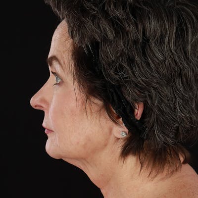 Neck Lift Before & After Gallery - Patient 211207 - Image 1