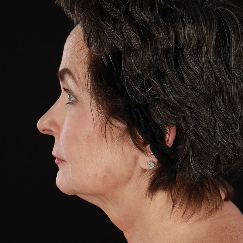 Neck Lift Before & After Gallery - Patient 211207 - Image 1