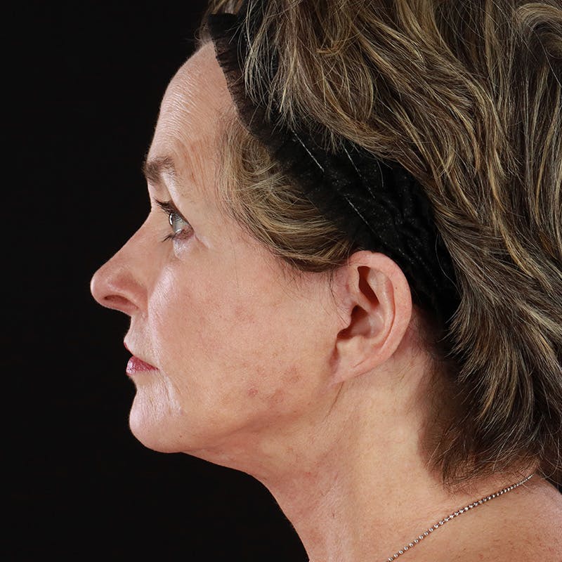 Neck Lift Before & After Gallery - Patient 211207 - Image 2