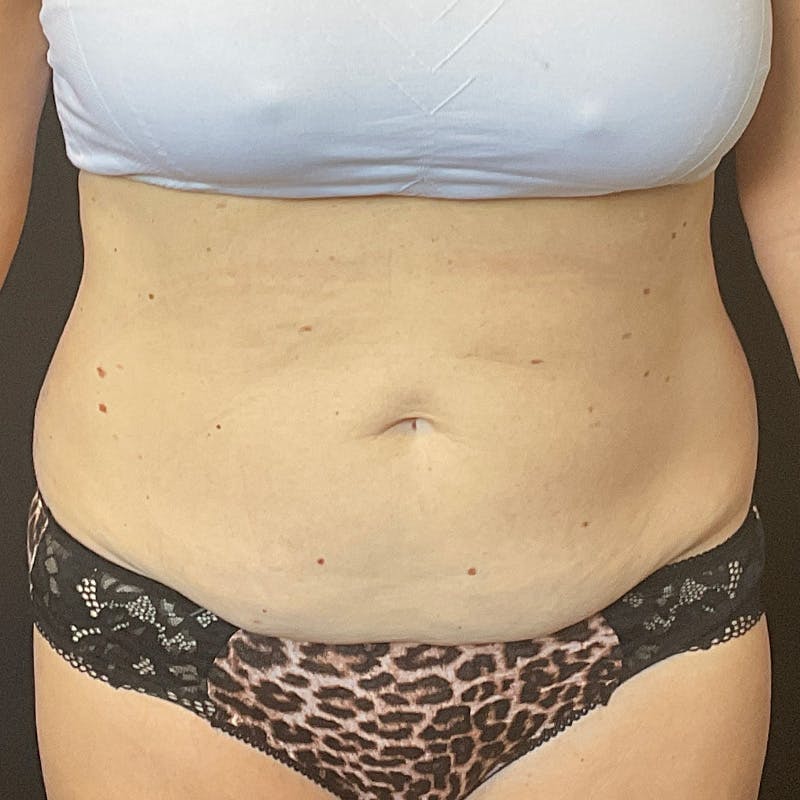 Abdominoplasty (Tummy Tuck) Before & After Gallery - Patient 486521 - Image 1