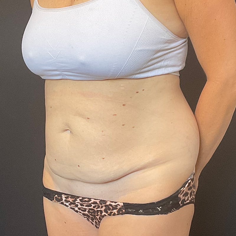 Abdominoplasty (Tummy Tuck) Before & After Gallery - Patient 486521 - Image 7