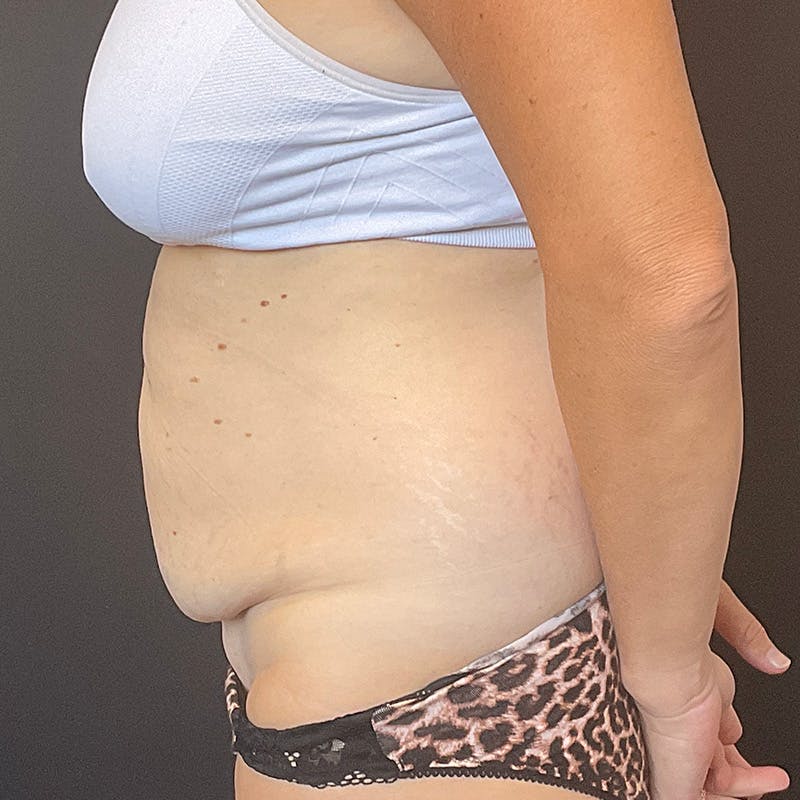 Abdominoplasty (Tummy Tuck) Before & After Gallery - Patient 486521 - Image 9
