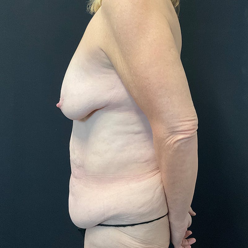 Abdominoplasty (Tummy Tuck) Before & After Gallery - Patient 144156 - Image 9