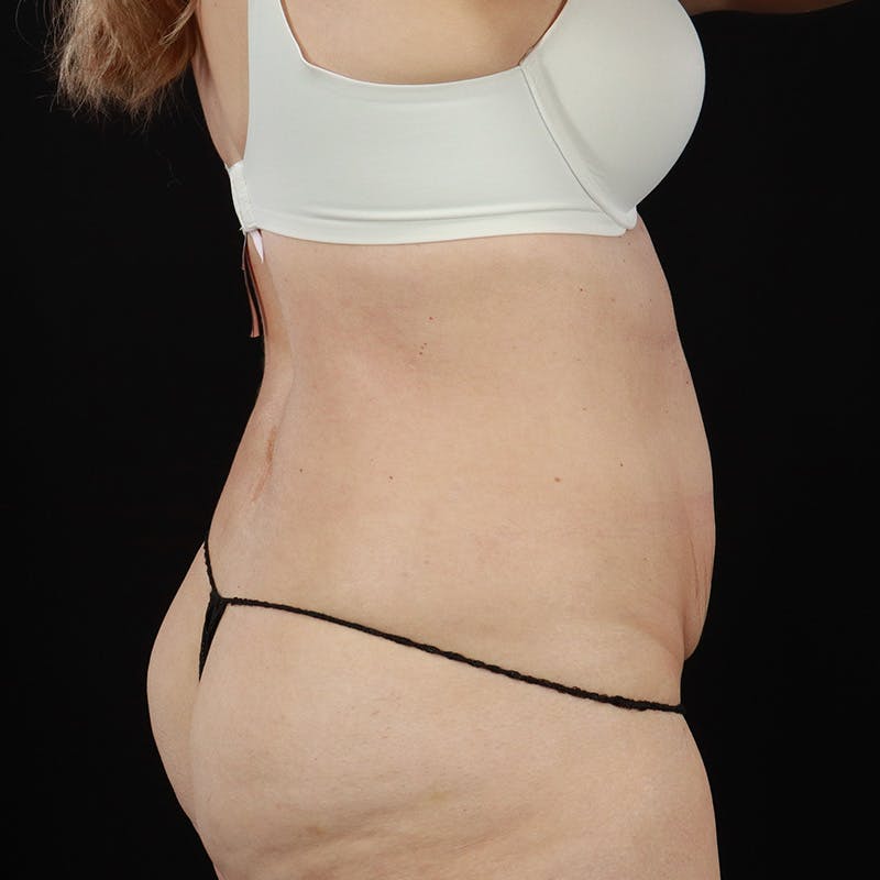 Abdominoplasty (Tummy Tuck) Before & After Gallery - Patient 384295 - Image 5