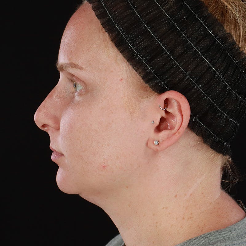 Chin Liposuction Before & After Gallery - Patient 393209 - Image 9