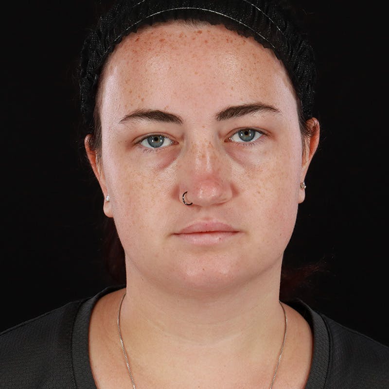 Chin Liposuction Before & After Gallery - Patient 158551 - Image 4