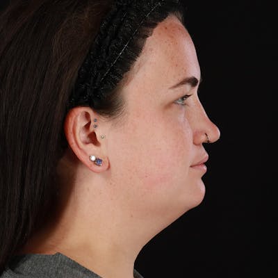 Chin Liposuction Before & After Gallery - Patient 158551 - Image 1