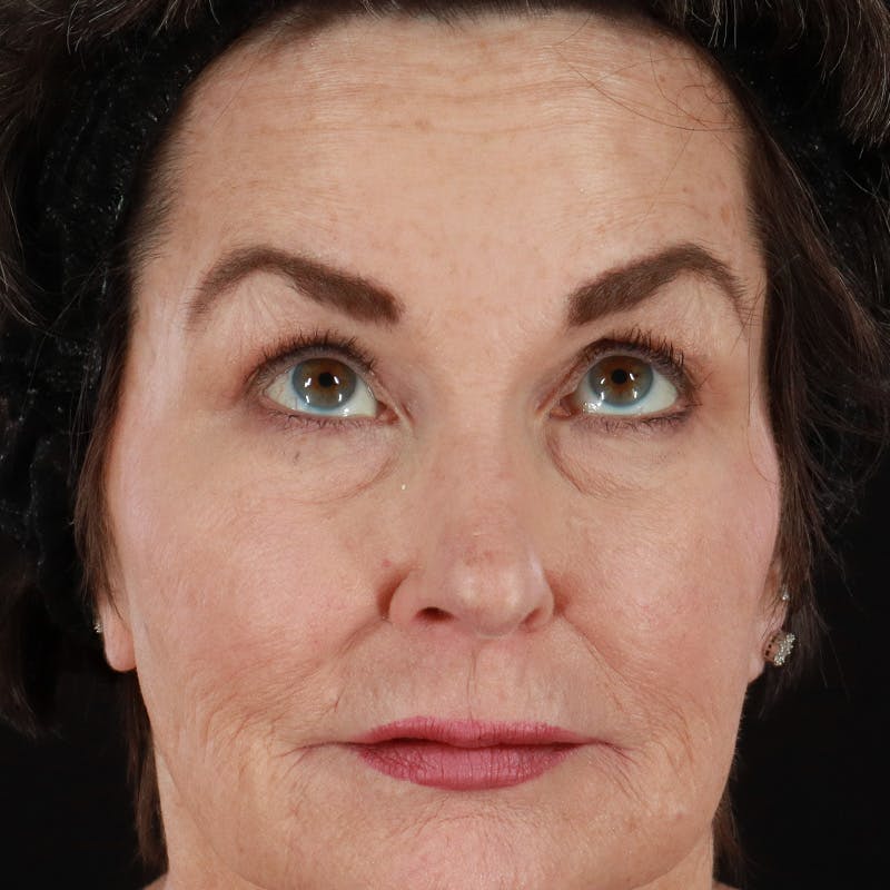 Lower Eyelid Surgery Before & After Gallery - Patient 167472 - Image 1