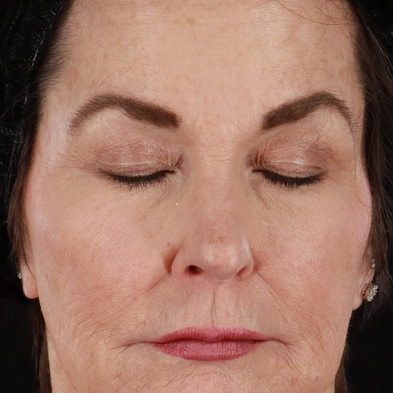Upper Eyelid Surgery Before & After Gallery - Patient 249145 - Image 3