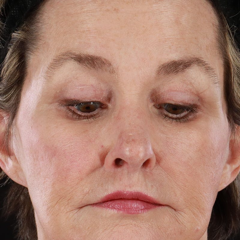 Upper Eyelid Surgery Before & After Gallery - Patient 249145 - Image 4
