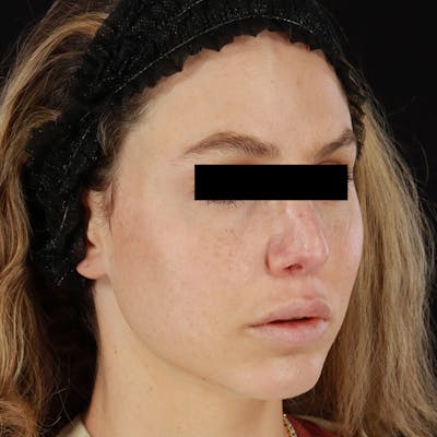 Microneedling Before & After Gallery - Patient 237171 - Image 1