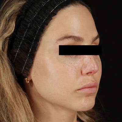 Microneedling Before & After Gallery - Patient 237171 - Image 2