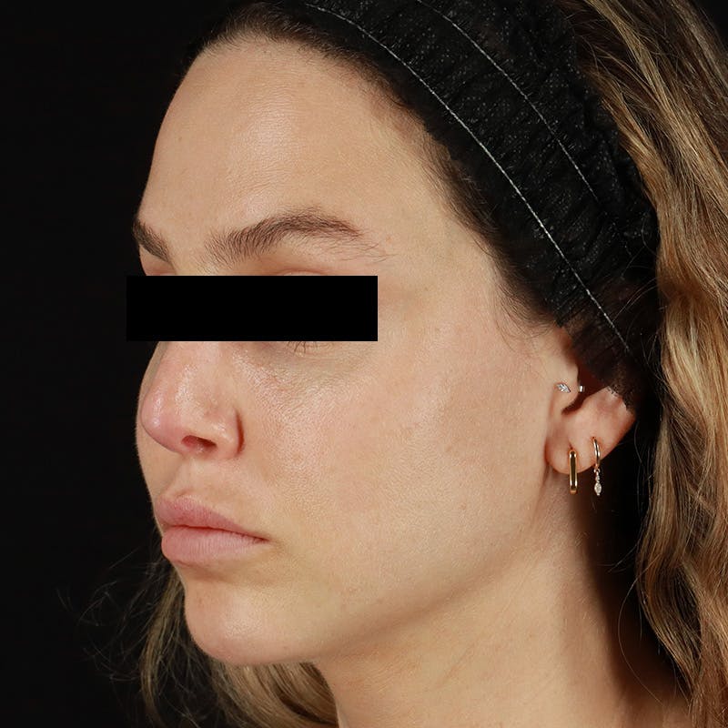 Microneedling Before & After Gallery - Patient 237171 - Image 6