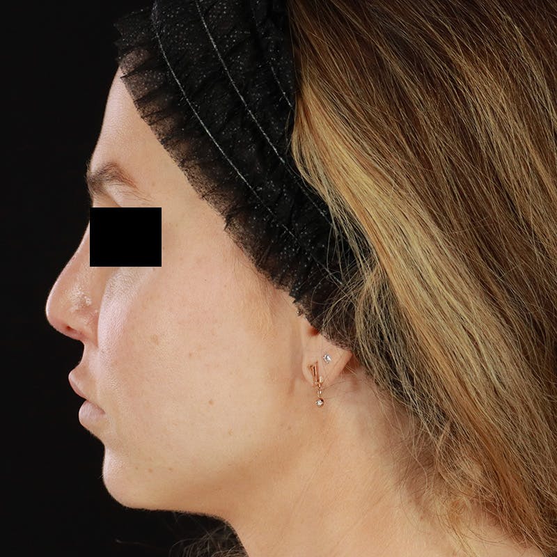 Microneedling Before & After Gallery - Patient 237171 - Image 7