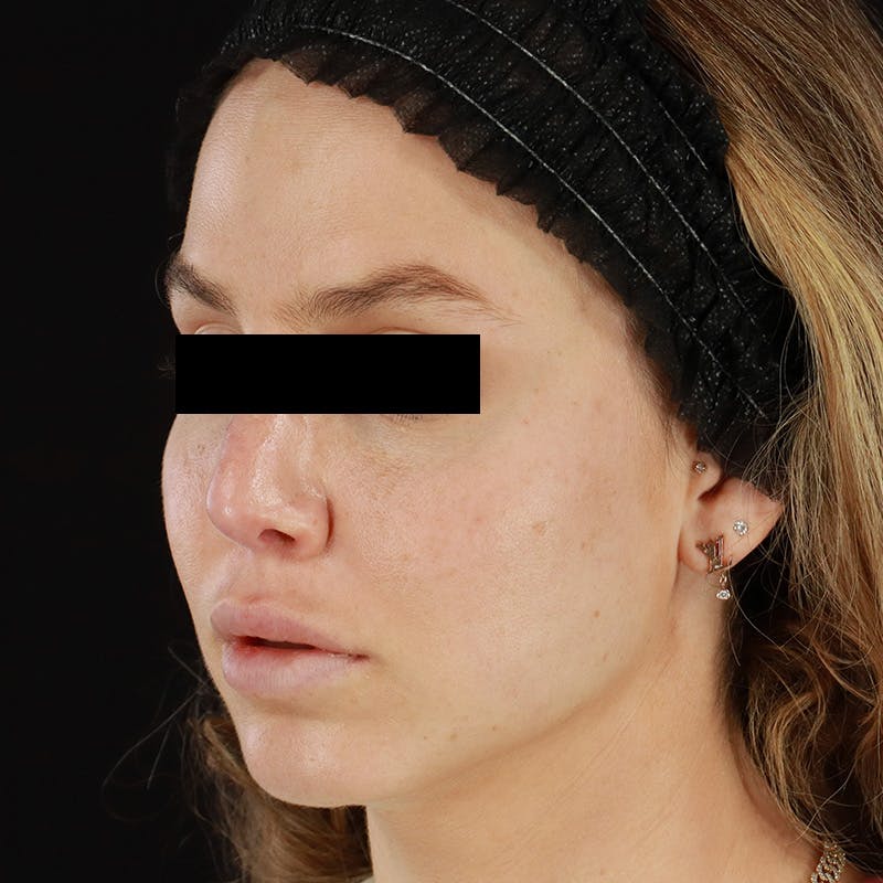 Microneedling Before & After Gallery - Patient 237171 - Image 5