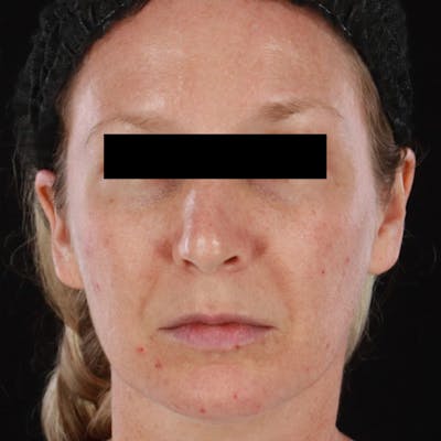 Morpheus8 Before & After Gallery - Patient 449897 - Image 1