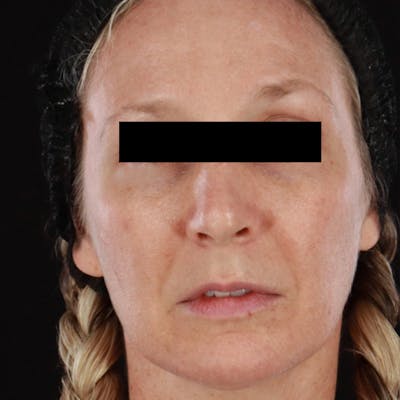 Morpheus8 Before & After Gallery - Patient 449897 - Image 2