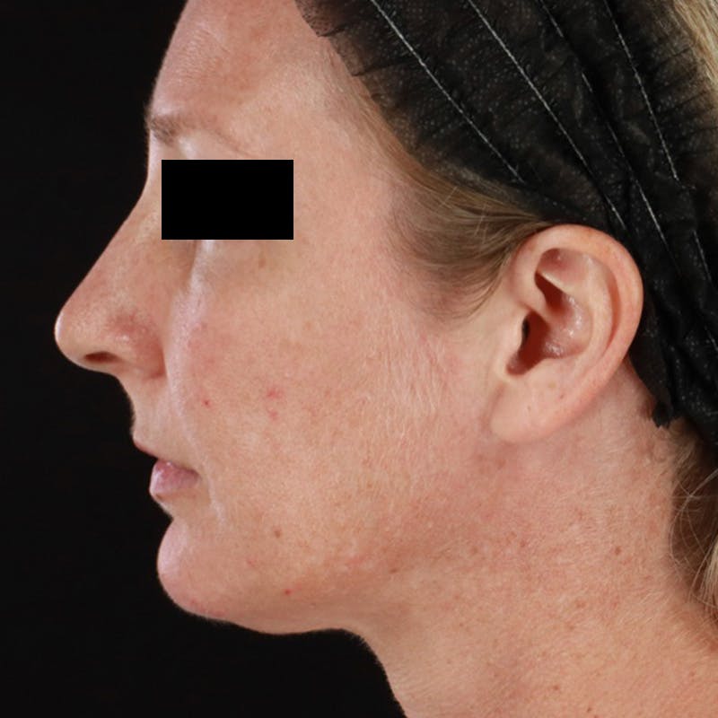 Morpheus8 Before & After Gallery - Patient 449897 - Image 7