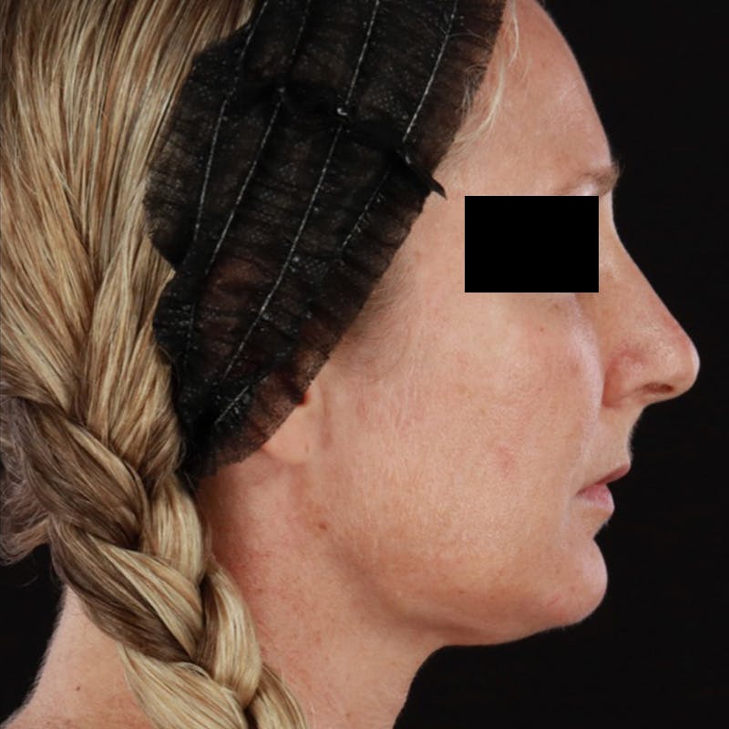 Morpheus8 Before & After Gallery - Patient 449897 - Image 10