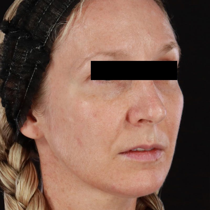 Morpheus8 Before & After Gallery - Patient 449897 - Image 4