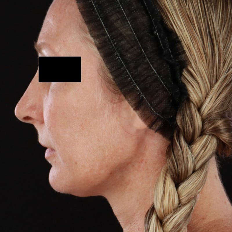 Morpheus8 Before & After Gallery - Patient 449897 - Image 8