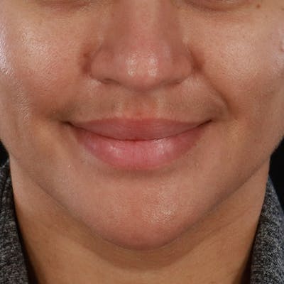 Dermal Fillers Before & After Gallery - Patient 218118 - Image 1