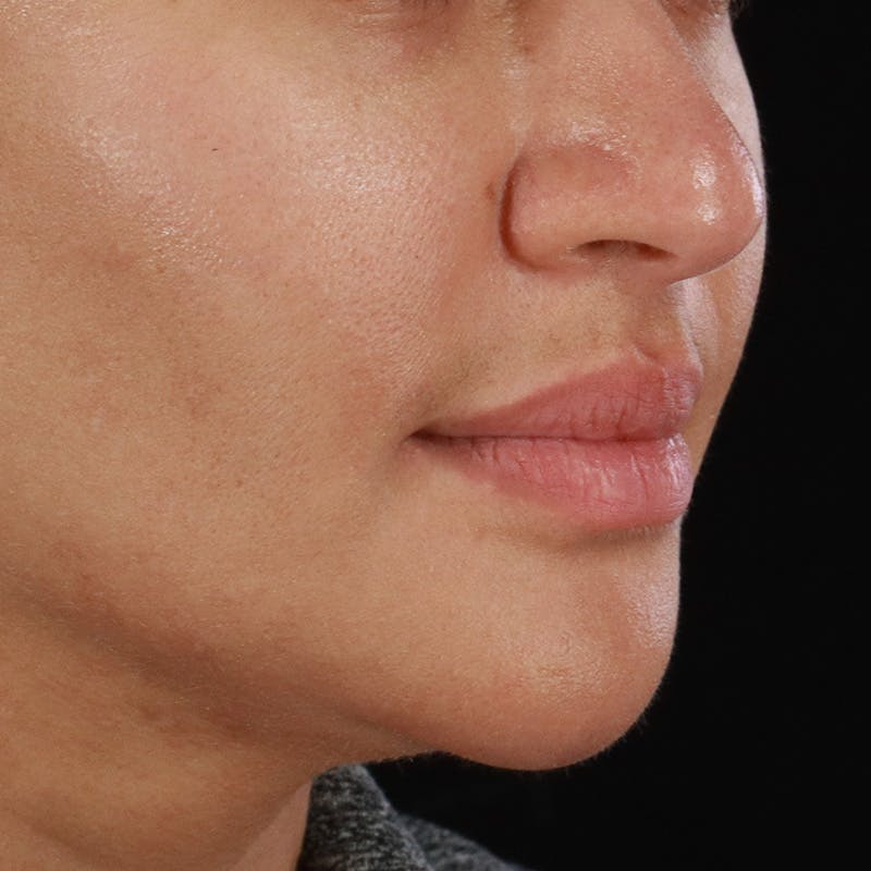 Dermal Fillers Before & After Gallery - Patient 218118 - Image 3