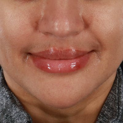 Dermal Fillers Before & After Gallery - Patient 218118 - Image 2