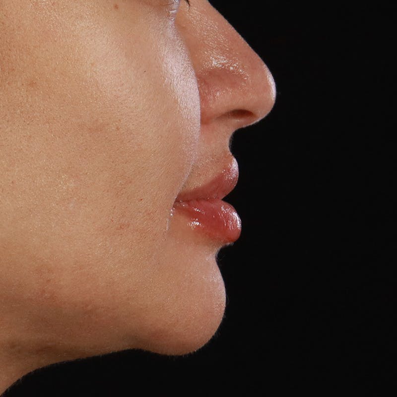 Dermal Fillers Before & After Gallery - Patient 218118 - Image 6