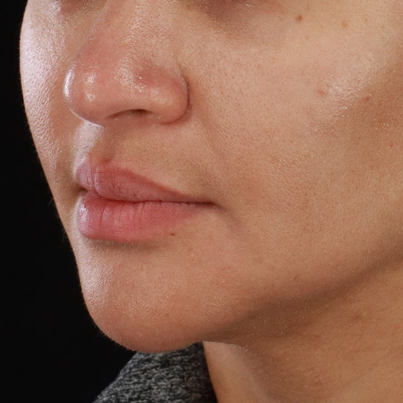 Dermal Fillers Before & After Gallery - Patient 218118 - Image 7