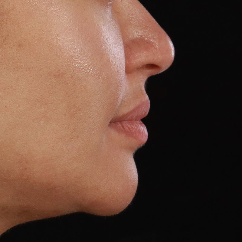 Dermal Fillers Before & After Gallery - Patient 218118 - Image 5