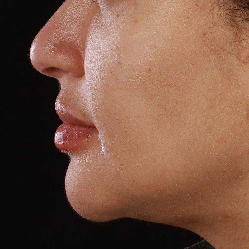 Dermal Fillers Before & After Gallery - Patient 218118 - Image 10