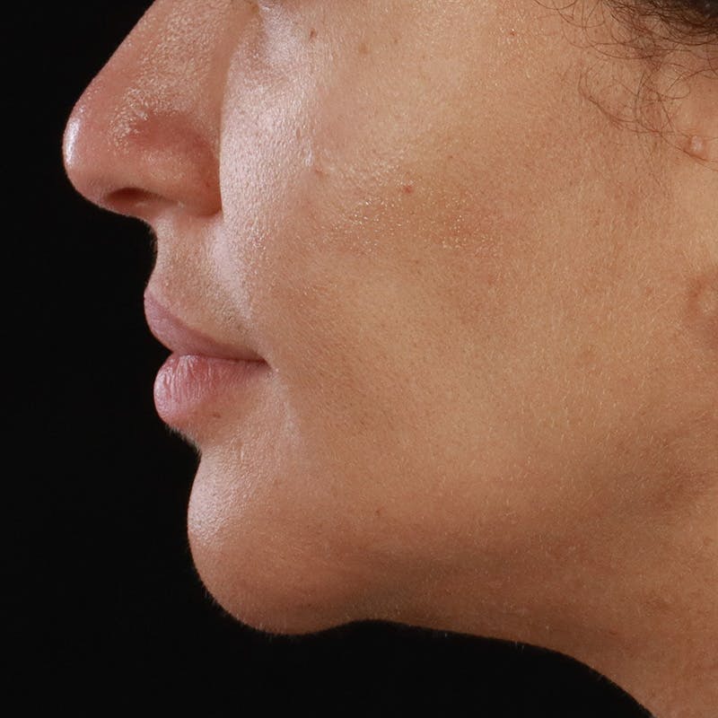 Dermal Fillers Before & After Gallery - Patient 218118 - Image 9