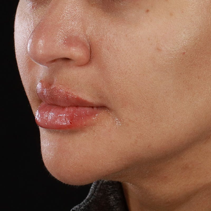 Dermal Fillers Before & After Gallery - Patient 218118 - Image 8