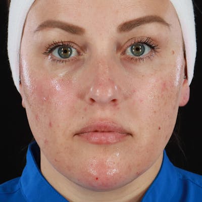 Dermal Fillers Before & After Gallery - Patient 550077 - Image 2