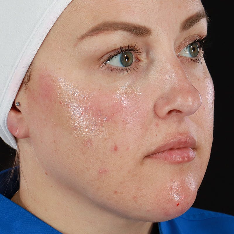 Dermal Fillers Before & After Gallery - Patient 550077 - Image 4