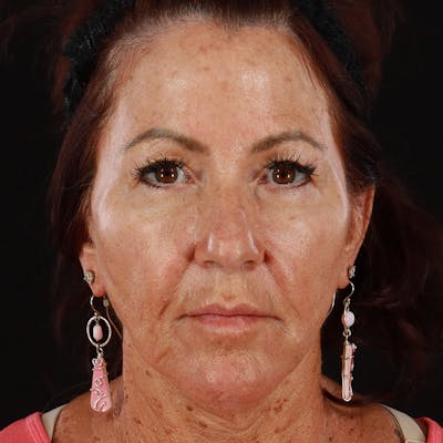 Dermal Fillers Before & After Gallery - Patient 217101 - Image 1