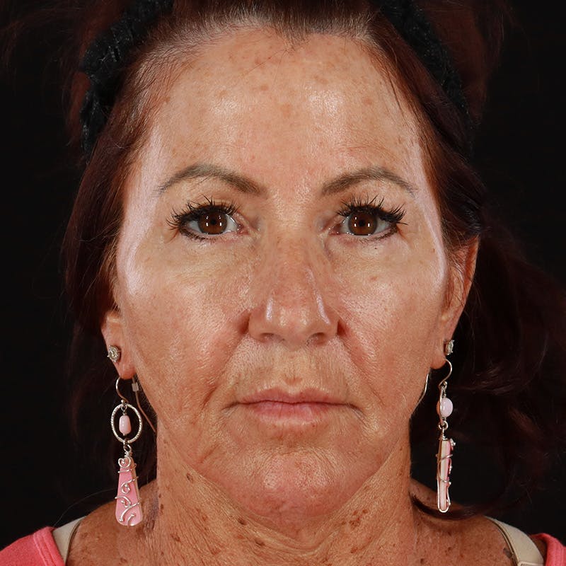 Dermal Fillers Before & After Gallery - Patient 217101 - Image 1