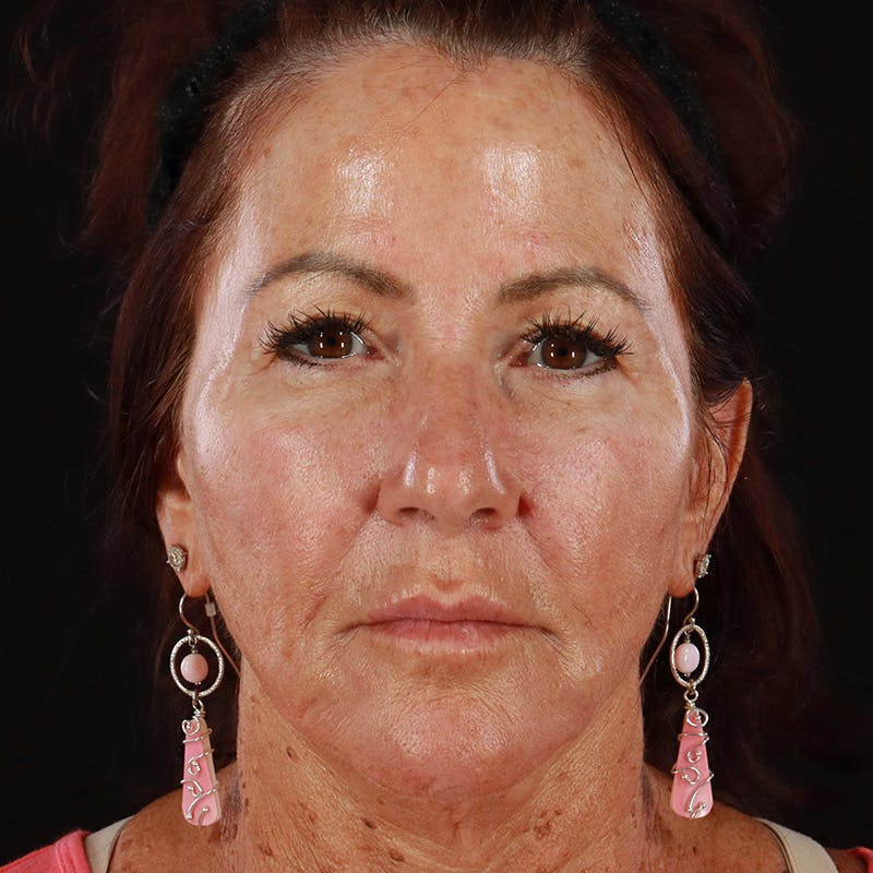 Dermal Fillers Before & After Gallery - Patient 217101 - Image 2