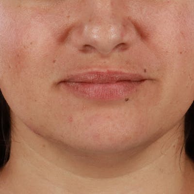 Dermal Fillers Before & After Gallery - Patient 158983 - Image 1