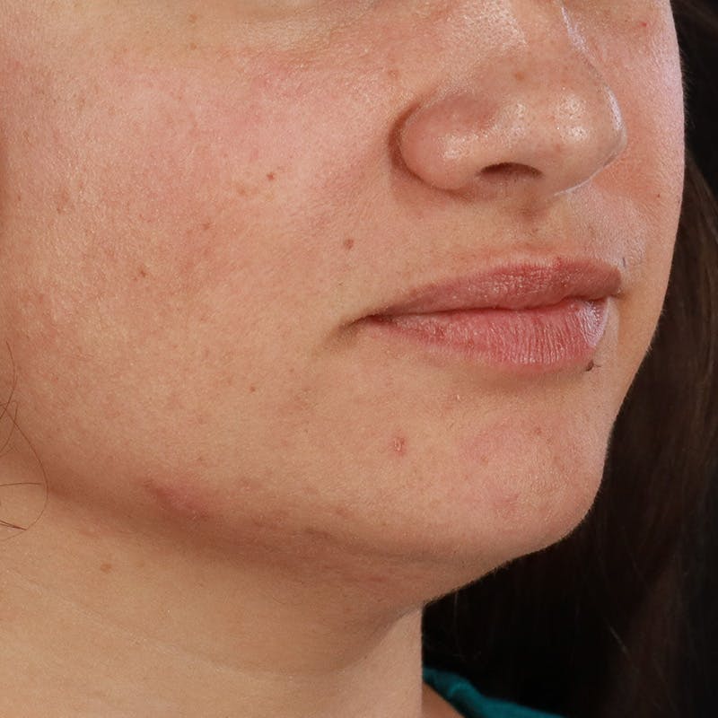 Dermal Fillers Before & After Gallery - Patient 158983 - Image 3