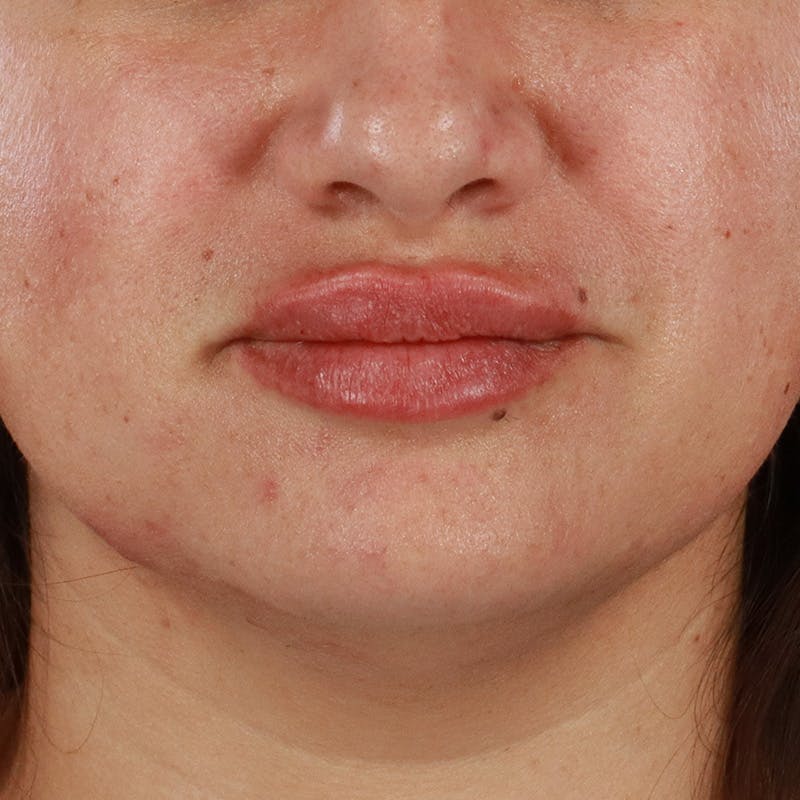 Dermal Fillers Before & After Gallery - Patient 158983 - Image 2