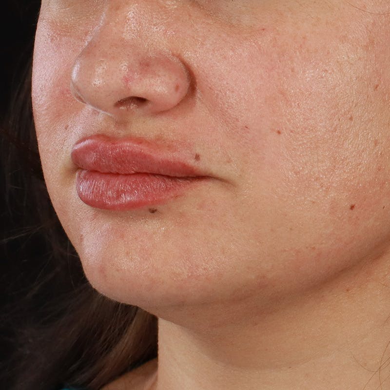 Dermal Fillers Before & After Gallery - Patient 158983 - Image 6