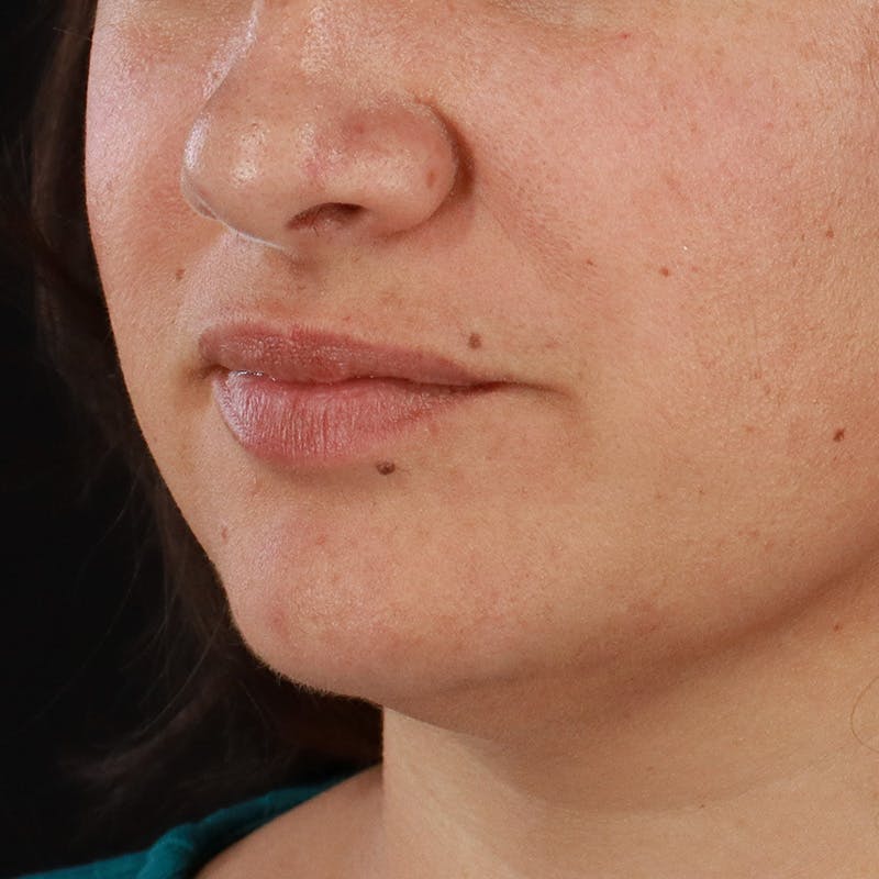 Dermal Fillers Before & After Gallery - Patient 158983 - Image 5
