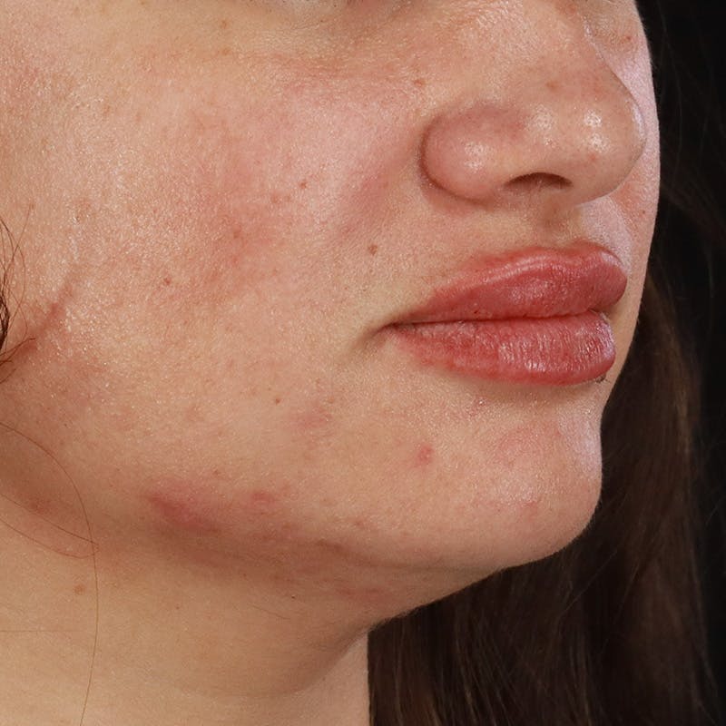 Dermal Fillers Before & After Gallery - Patient 158983 - Image 4