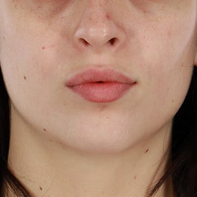 Dermal Fillers Before & After Gallery - Patient 126980 - Image 1