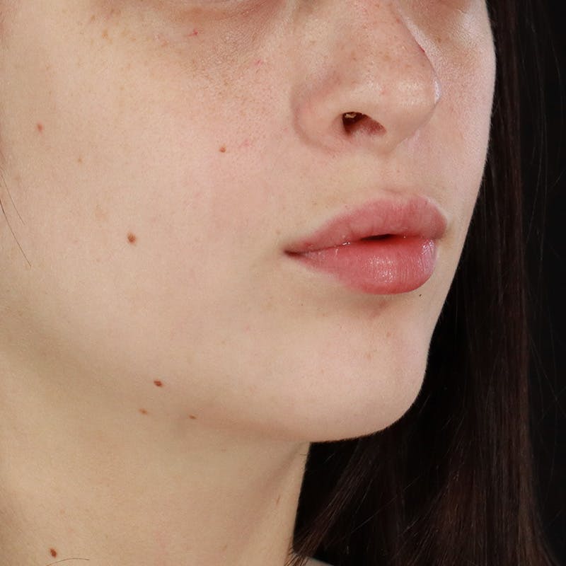 Dermal Fillers Before & After Gallery - Patient 126980 - Image 3