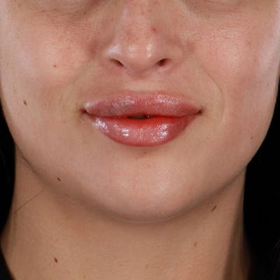 Dermal Fillers Before & After Gallery - Patient 126980 - Image 2