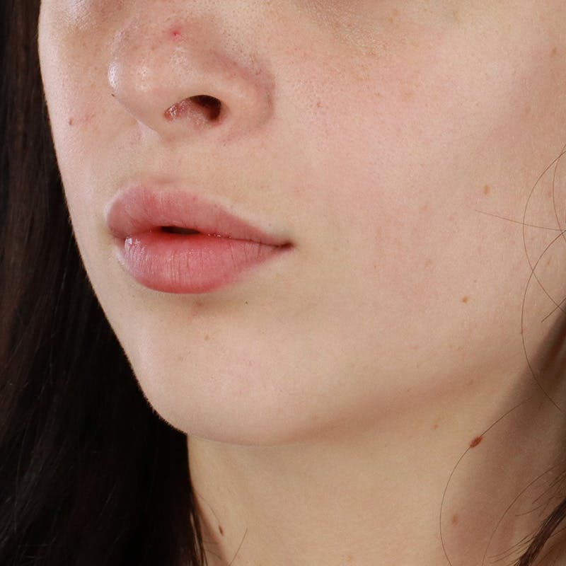 Dermal Fillers Before & After Gallery - Patient 126980 - Image 7